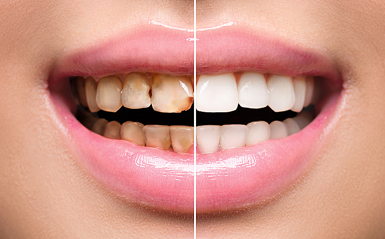 Will Tooth Decay Go Away? Reverse It with These Techniques!